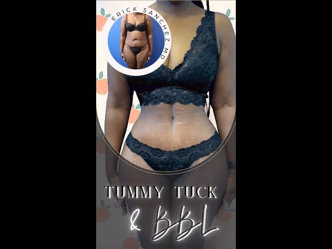 Tummy Tuck with Brazilian Butt Lift by Dr. Erick Sanchez in Baton Rouge, LA